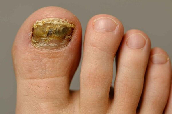 DERMATOFITA